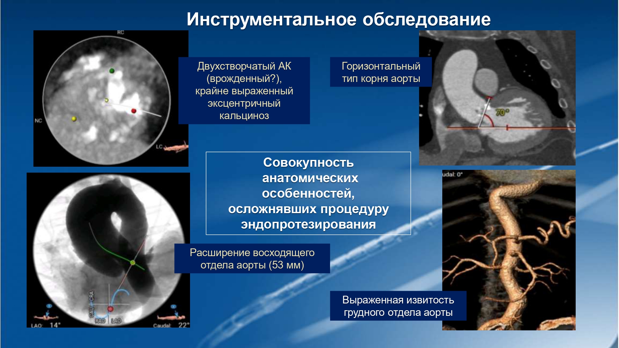 Аномалии аорты пациента.jpg